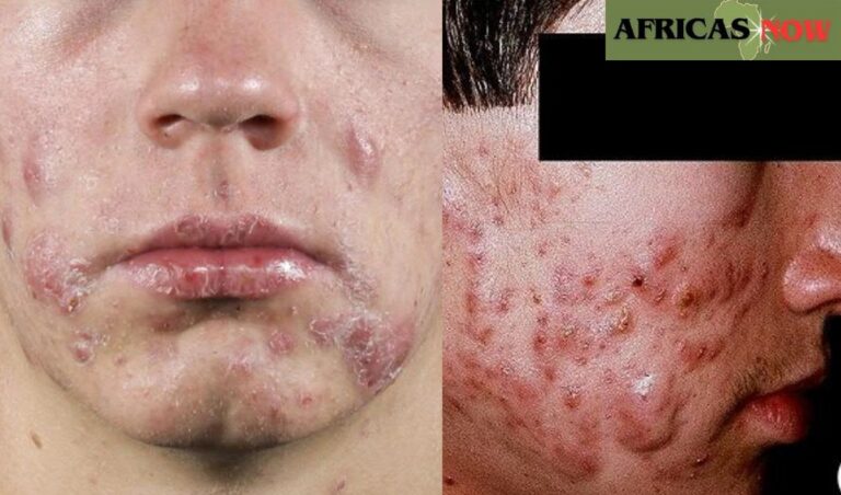 RESEARCH: What is ACNE and how to get rid of it?