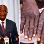 Kenya Confirms Third Mpox Case In Nairobi
